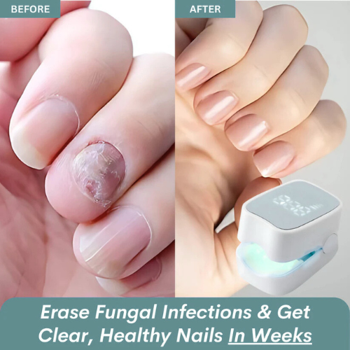 Shopnest™ - Nail Fungus Laser Device