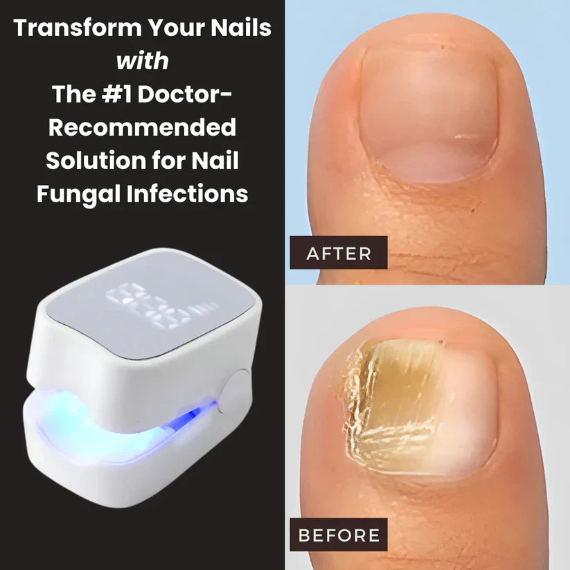 Shopnest™ - Nail Fungus Laser Device